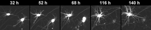 Последовательные изображения двух нейронов, полученные в течение пяти дней. Верхний нейрон чувствует себя хорошо на протяжении всех пяти дней, в то время как нижний начинает дегенерировать на третий день. На четвертый день он погибает. Отслеживая судьбу нейронов в динамике, ученые имеет гораздо больше возможностей обнаружить различия между нейронами с нормальной и мутантной киназой LRRK2.