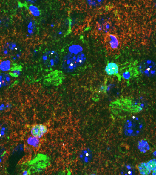 Звездчатые клетки астроциты (зеленые) в мозговой ткани мыши. В синих клетках, содержащих мутантный хантингтин (белый), наблюдаются более низкие уровни белка, регулирующего поступление калия (красный).