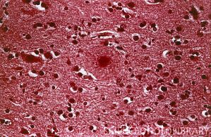 Срез мозга пациента с болезнью Альцгеймера. Сенильные бляшки (большие красные кружки, например, в центре)  - характерная черта болезни Альцгеймера.
