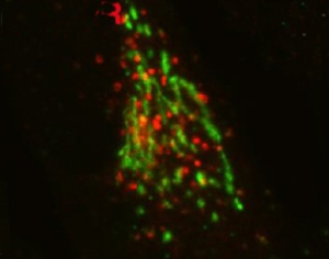 Специфическая мутация в компоненте ретромера  VPS35 связывает дисфункцию ретромера с семейной аутосомно-доминантной и  спорадической болезнью Паркинсона. Однако эффект этой мутации на функцию  ретромера изучен недостаточно. Питер Кален и его коллеги установили,  что в клетках, экспрессирующих мутантный VPS35, происходит нарушение  транспорта карго-белков из эндосом в сеть Гольджи. На верхнем снимке  показано распределение определенного карго-белка (красный) в клетках  пациента с болезнью Паркинсона, несущих мутацию в гене VPS35. На нижнем  снимке видно, что распределение того же карго-белка в клетках,  экспрессирующих немутантный ген VPS35, носит более нормальной кластерной  характер.