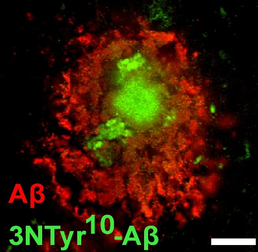 Белковые отложения в головном мозге человека: зеленым показан нитрованный, красным – не нитрованный бета-амилоид в бляшках.