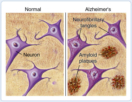 Образование бета-амилоидных бляшек и нейрофибриллярных клубков вносит вклад в деградацию нейронов головного мозга и последующее развитие симптомов болезни Альцгеймера.