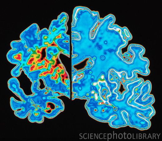 Болезнь Альцгеймера. Компьютерная графика вертикального среза мозга пациента с болезнью Альцгеймера (слева) в сравнении с нормальным мозгом. Объем мозга при болезни Альцгеймера (коричневый) значительно сокращается из-за дегенерации и гибели нейронов. Наряду с уменьшением объема становится более складчатой поверхность мозга. Болезнь Альцгеймера составляет большинство случаев старческого слабоумия.