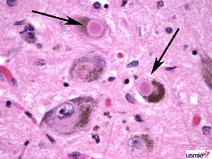 Тельца Леви – округлые эозинофильные цитоплазматические включения в нейронах черной субстанции при болезни Паркинсона и в коре головного мозга пациентов с деменцией с тельцами Леви. Тельца Леви состоят из тонких нитей белка альфа-синуклеина.