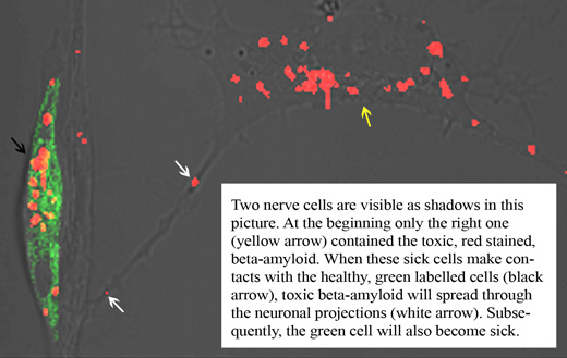 Две нервные клетки, каждая размером около 10 мкм, видны как тени. Сначала только правая клетка (желтая стрелка) содержала токсичный, окрашенный красным, олигомерный бета-амилоид. Когда эти больные клетки установили контакты со здоровыми, помеченными зеленым, нейронами (черная стрелка), токсичный бета-амилоид распространился в здоровые клетки по нейрональным отросткам (белые стрелки).