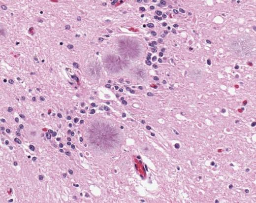 Световая микрофотография ткани головного мозга показывает присутствие типичных амилоидных бляшек  в одном из случаев варианта  болезни Кройтцфельдта-Якоба (vCJD), являющегося прионным заболеванием. Вариант болезни Кройтцфельдта-Якоба   впервые описан в 1996 году в Великобритании. В настоящее время существуют убедительные научные доказательства того, что губчатая энцефалопатия крупного рогатого скота («коровье бешенство») и vCJD вызываются одним и тем же агентом. Оба заболевания – неизбежно заканчивающиеся смертельным исходом болезни мозга с необычно длинным инкубационным периодом,  измеряемым  годами, вызываемые передающимся агентом – прионом.