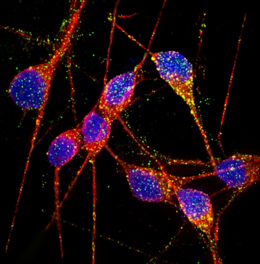 Нейроны, полученные из индуцированных плюрипотентных стволовых клеток пациентов с болезнью Альцгеймера, - новый инструмент для изучения механизмов, лежащих в основе нейродегенеративных заболеваний. ДНК показана синим цветом, дендриты и тела клеток – красным, эндосомальные маркеры Rab5 и EEA1 – зеленым и оранжевым, соответственно.