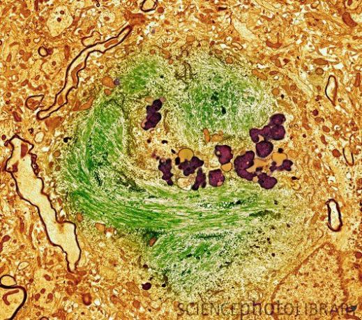 Нейрофибриллярный клубок в клетке головного мозга при болезни Альцгеймера. Нейрофибриллярный узел (зеленый) находится в цитоплазме (оранжевая) клетки и состоит из аномальных агрегатов тау-белка. В здоровой клетке тау-белок стабилизирует микротрубочки. (ТЭМ)