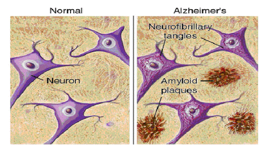 Характерный признак болезни Альцгеймера бета-амилоидные бляшки, основным компонентом которых является пептид бета-амилоид, образуются в межклеточном пространстве ткани головного мозга и нарушают синаптическую функцию нейронов.
