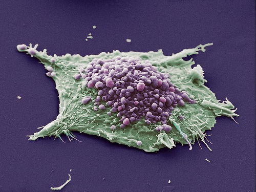 Клетка рака легких
