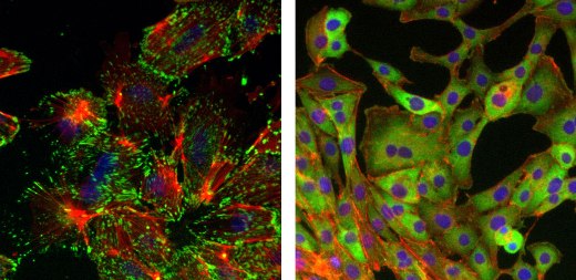 Эпителиальные клетки молочной железы, подвергшиеся эпителиально-мезенхимальному переходу (слева), демонстрируют морфологическое изменение, касающееся актиновых стрессовых волокон (красные) и фокусированных точек клеточной адгезии (зеленые). При отсутствии фактора транскрипции Sox4 (справа) этого изменения не наблюдается, и раковые клетки не могут мигрировать и не образуют метастазов.