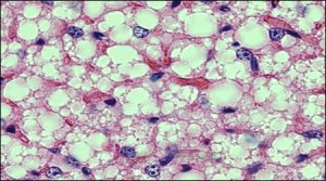 Электронная микрофотография клеток бурой жировой ткани демонстрирует одну из их характерных черт – чрезвычайно большое количество митохондрий, генерирующих тепло.