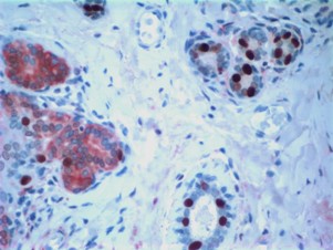 Ткань молочной железы с раковыми стволовыми клетками (показаны красным).