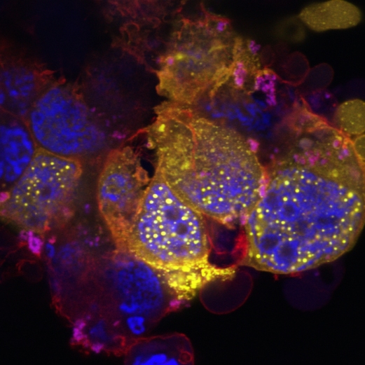 Сферические структуры в ядре клетки. Флуоресцентная микроскопия показывает несколько клеток, выращенных в лаборатории. В ядре (показано синим) белок FE65 слит с другими белками, такими как BLM, образуя сферические структуры (показаны желтым). Красным показан белковый цитоскелет.