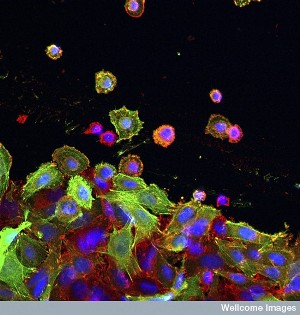 Клетки рака толстой кишки в культуре. Ядра клеток окрашены синим, актиновый цитоскелет – красным, плектин (изоформа 1k) – зеленым. Плектин взаимодействует с актином цитоскелета, оказывая влияние на его функции. Показанный здесь тип плектина способствует миграции клеток и может стимулировать метастазирование.