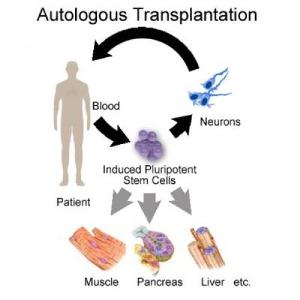 Возможные варианты пересадки аутологичных трансплантатов. В статье японских исследователей описаны результаты аутологичных трансплантаций только нейральных клеток. Иммуногенность полученных из ИПСК клеток других органов требует дальнейшего изучения.
