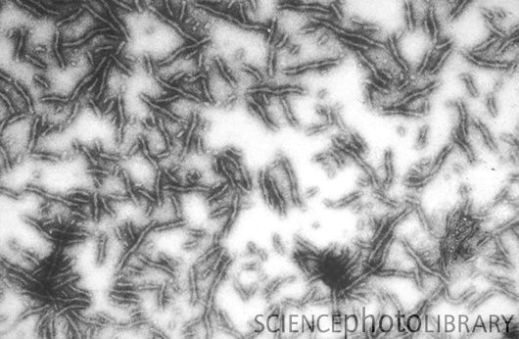 Микрофотография (ТЭМ) нейрофибриллярных клубков. Эти скопления белковых волокон часто обнаруживаются в нейронах пациентов с нейродегенеративными заболеваниями, такими как болезнь Альцгеймера и болезнь Паркинсона. Волокна состоят из тау-белка, функционально связанного с микротрубочками клетки, являющимися частью ее цитоскелета. Добавление к тау-белку фосфатной группы изменяет его форму и способствует образованию агрегатов – нейрофибриллярных клубков (темные кластеры в левом углу и внизу справа). С открытием в нейрофибриллярных клубках еще двух белков эта информация, очевидно, является неполной.