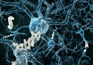 Амилоидные бляшки на аксонах нейронов, пораженных болезнью Альцгеймера.