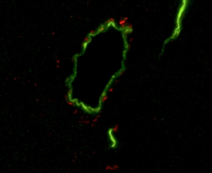 Кровеносные сосуды в мозге мыши (зеленые), окруженные бета-амилоидом (красный) – компонентом амилоидных бляшек, обнаруживаемых в мозге пациентов с болезнью Альцгеймера. Ученые из Института Солка установили, что бета-амилоид накапливается в мозге как мышей с моделью диабета, так и старых животных. Это открытие может помочь объяснить связь между диабетом и болезнью Альцгеймера.