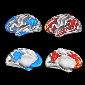 Ученые Школы медицины Вашингтонского университета в Сент-Луисе показали, что клетки областей сети пассивного режима работы мозга (синие в левом ряду), взаимодействуют друг с другом чаще, чем клетки  других областей мозга.  Это может помочь объяснить, почему именно эти области часто первыми поражаются бета-амилоидными бляшками, показанными красным на изображениях справа.
