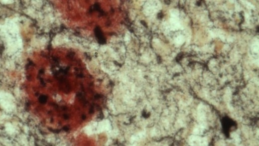 Бета-амилоидные бляшки (красные) и нейрофибриллярный клубок (черный, внизу справа) в мозге пациента с болезнью Альцгеймера.