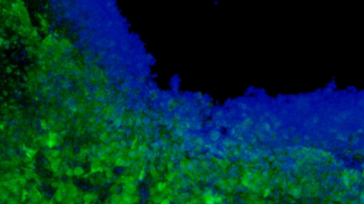 Инкапсулированные в биоразлагаемый гель синтезирующие цитотоксины стволовые клетки (синие) помогают убивать клетки раковой опухоли головного мозга в полости, оставшейся после ее резекции (зеленые).