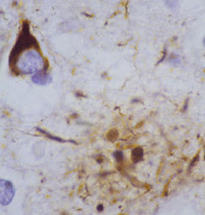 В мозге пациентов с болезнью Альцгеймера присутствуют как нейрофибриллярные клубки (вверху слева), так и бета-амилоидные  бляшки (внизу справа).