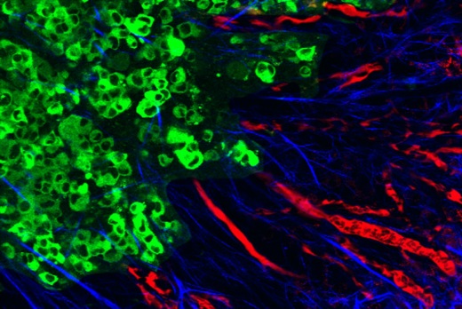 Процесс метастазирования в опухоли мыши, где опухолевые клетки (зеленые) помогли организовать коллаген в выровненные волокна (синие), обеспечивающие структурную поддержку миграции раковых клеток. Это помогает клеткам проникать в кровеносные сосуды (красные), что, в конечном счете, приводит к образованию метастазов в других органах.