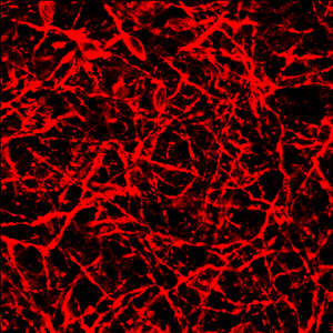 Нейроны (окрашены красным), несущие генетическую мутацию, делающую их предрасположенными к дегенерации. Они получены из клеток кожи взрослого пациента с лобно-височной дегенерацией. Их геном точно соответствует геному клеток пациента, и они могут быть использованы в качестве модели данного заболевания.