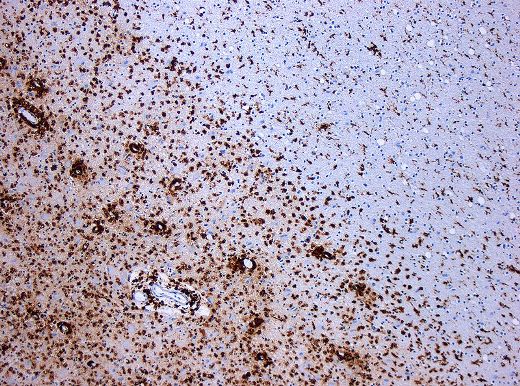 Демиелинизация при рассеянном склерозе. В окрашенной по CD68 ткани видны несколько макрофагов в зоне поражения.