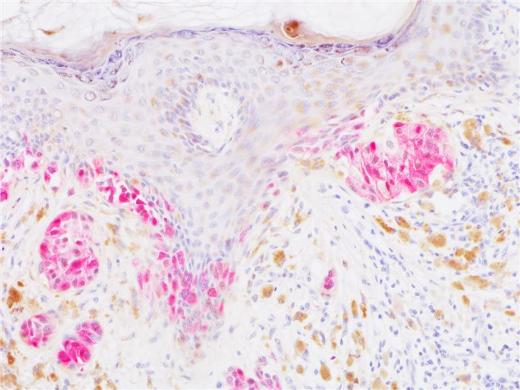 Бывшие клетки злокачественной опухоли (меланомы) (показаны красным), переведенные иммунной системой в состояние, характеризующееся прекращением деления, то есть сенесценцию.