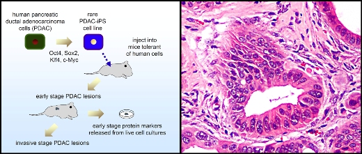 Слева: схема получения из клеток аденокарциномы протоков поджелудочной железы индуцированных плюрипотентных стволовых клеток (iPSCs), использованных для воспроизведения прогрессии рака и идентификации ранних маркеров заболевания. Справа:  инвазивная стадия опухоли, развивавшейся в течение 9 месяцев в организме иммунотолерантной мыши из человеческих индуцированных плюрипотентных стволовых клеток, полученных из клеток рака поджелудочной железы.