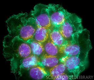 Иммунофлуоресцентная световая микрофотография скопления человеческих клеток рака молочной железы. Флуоресцентные красители использованы для выделения белков в клеточных ядрах (фиолетовые), аппарата Гольджи (желтый) и актина (зеленый). Синтез актина, структурного клеточного белка, инициирован нейрегулином, химическим фактором роста.