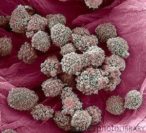 Клетки рака молочной железы. Сканирующая электронная микроскопия