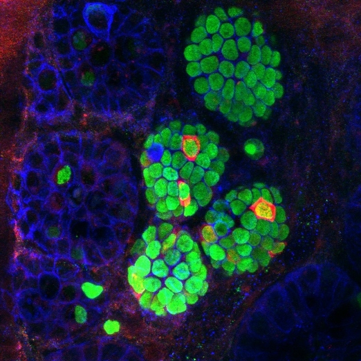 Инсулин-экспрессирующие клетки (красные), появляющиеся среди клеток кишечных крипт мыши (зеленые), получившей три фактора перепрограммирования в бета-клетки.