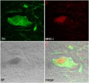 Четыре снимка нейрона (показан зеленым) человеческого головного мозга демонстрируют, что эти клетки продуцируют белок (показан красным), который может направить на них иммунную атаку.
