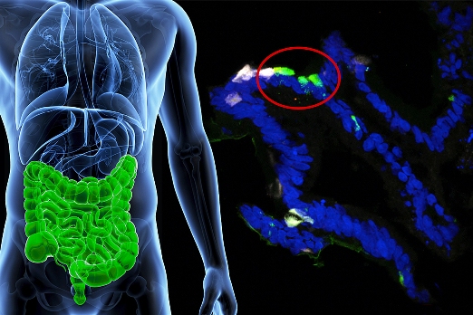 В in vitro экспериментах ученые «научили» клетки человеческого кишечника вырабатывать инсулин (флуоресцирует зеленым).