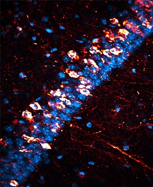 Нейрофибриллярные клубки в пирамидальных нейронах (окрашены ярко-красным) – один из признаков болезни Альцгеймера.