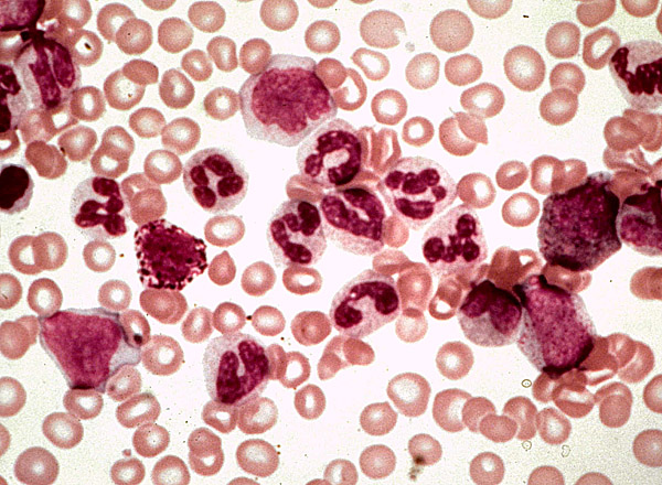 Клетки крови при хроническом миелоидном лейкозе