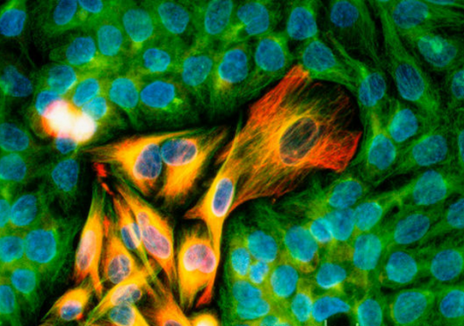 Клетки меланомы в окружении нормальных клеток эпителия