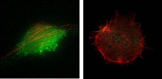 Клетка меланомы (слева) и подобная стволовой клетке клетка инвазивной меланомы с окрашенным красным белком актином.