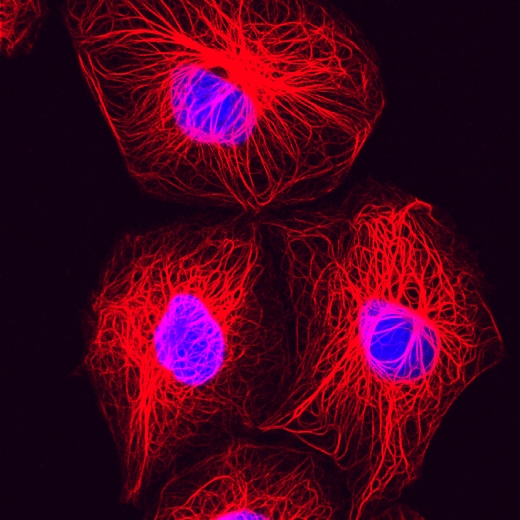 Клетки рака молочной железы. Красным показаны белки цитоскелета.