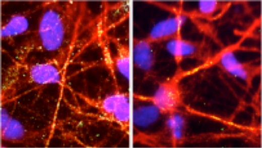 Олигомеры бета-амилоида в нейронах больного с семейной формой болезни Альцгеймера (слева) и больного со спорадической формой заболевания.