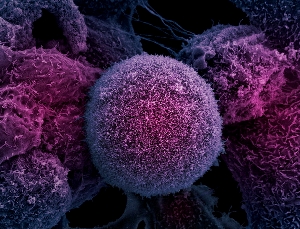 Клетка раковой опухоли простаты