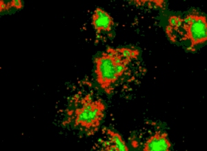 Раковые клетки. Простой цветовой код делает несложной их визуальную идентификацию. Красное свечение указывает на  присутствие биомаркеров рака.