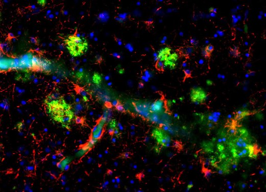 Как установлено в последнее десятилетие, характерной особенностью бета-амилоидных бляшек (зеленые) в коре головного мозга пациентов с болезнью Альцгеймера является их образование в непосредственной близости от микрососудов. Амилоид (зеленый) откладывается и в стенках сосудов. Сосуд на снимке отчетливо виден благодаря клеткам астроглии (красные). Ядра окрашены синим.
