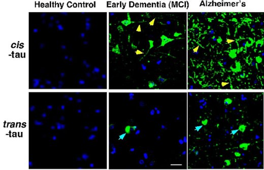Разработка новых антител сделала возможным проведение различия между двумя формами тау-протеина и показала, что патологическая цис-форма появляется в клетках головного мозга у больных с ранней деменцией. В процессе прогрессирования ранней деменции в болезнь Альцгеймера цис-форма быстро накапливается в областях мозга, имеющих решающее значение для памяти.