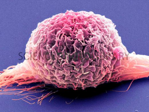 Клетка рака мочевого пузыря, SEM.