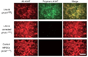 Иммунофлуоресценция показывает отсутствие полимерного белка А1АТ в гепатоцитоподобных клетках, полученных из скорректированных iPSCs. Показаны все формы А1АТ (левая панель) и неправильно свернутый полимерный А1АТ (средняя панель).
