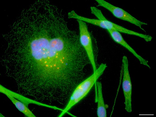 Флуоресцентное микроскопическое изображение гигантской многоядерной межфазной клетки меланомы, содержащей, по меньшей мере, 18 центросом (видимых как оранжевые точки) вместо одной или двух центросом, присутствующих практически во всех нормальных клетках животных. Вторая клетка с более нормальной морфологией имеет два ядра и содержит кластер из четырех центросом. Нарушение количества центросом ведет к неправильному распределению генома при делении клетки и таким образом порождает генетические и фенотипические различия между ее потомками. Этим могут объясняться происхождение и быстрая прогрессия меланомы, а также печально известная резистентность к системной терапии при метастазировании.